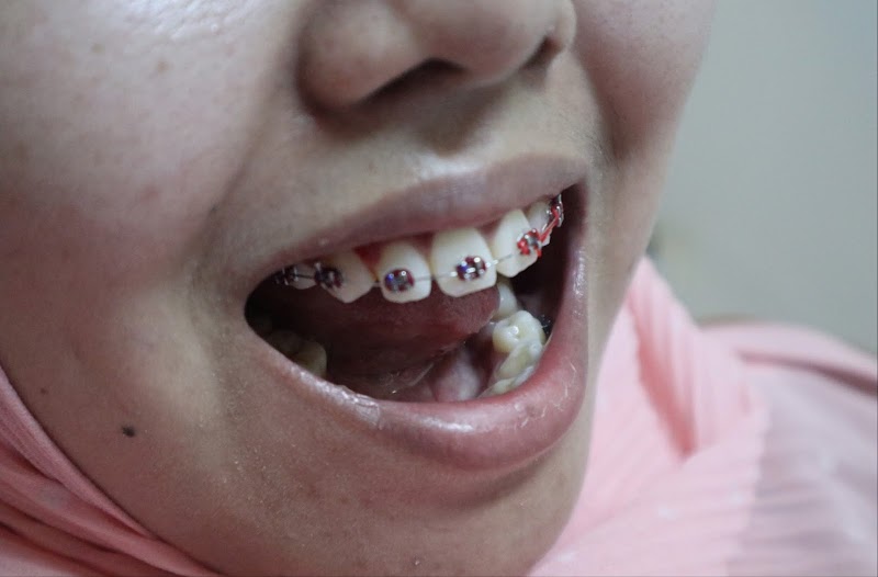 Smile Dental | Veneer Gigi | Behel Gigi in Tanah Abang